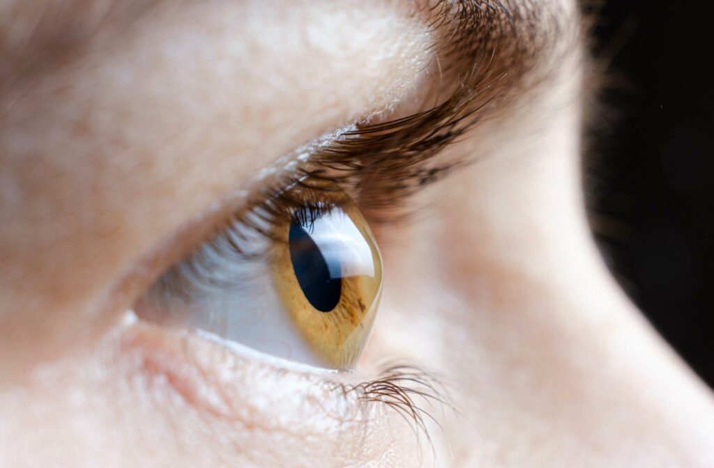 A close up of an eye with keratoconus, showing the bulging cornea.